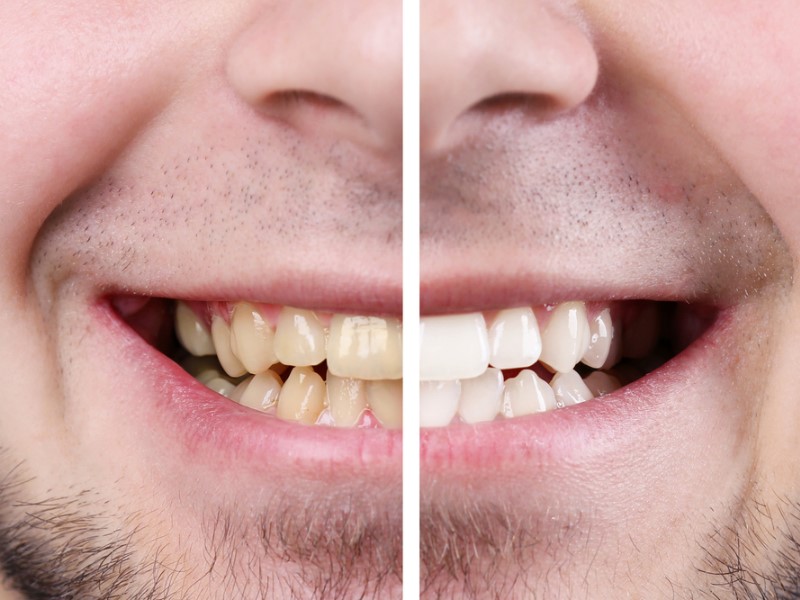 Professional teeth whitening is the ideal choice for best results.